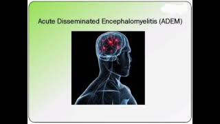 ADEM Acute disseminated encephalomyelitis History Management mrcpch Clinical [upl. by Aramoiz54]