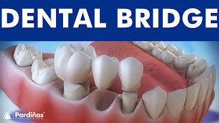 Dental bridge  Fixed dental replacement © [upl. by Judus]