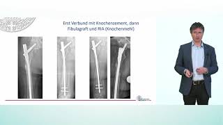 Chirurgische Optionen bei Knochenmetastasen im Bereich der Extremitäten  Prof Dr Hagen Schmal [upl. by Eisen]