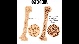 Osteopenia [upl. by Ashla139]