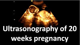 Ultrasonography of 20 weeks pregnancy  Sonographic findings [upl. by Forelli]