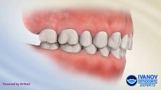 What is Normal Teeth and Bite Occlusion [upl. by Sehguh]