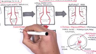 Abdominal Aortic Aneurysm  Summary [upl. by Good406]