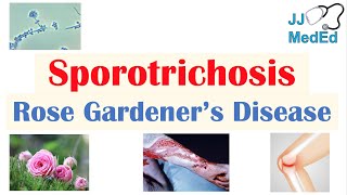 Sporotrichosis Rose Gardener’s Disease Causes Risks Types Symptoms Diagnosis Treatment [upl. by Todd288]