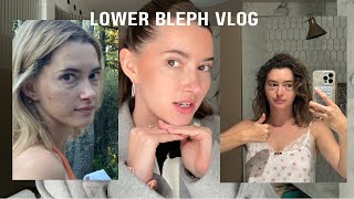 I got plastic surgery Lower blepharoplasty vlog [upl. by Ruenhcs]