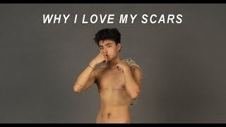 WHY I LOVE MY SCARS [upl. by Tioneb]