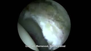 Hip Labral Reconstruction [upl. by Adnarrim350]