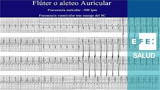 Taquicardia Aleteo y fibrilación auricular [upl. by Amehsat]