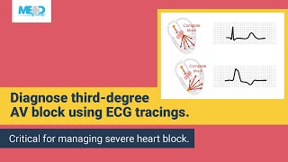 Examining a thirddegree AV block [upl. by Tuck]