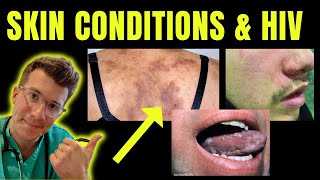 Doctor explains skin conditions associated with HIV  AIDS eg Kaposi sarcoma candida amp more [upl. by Auberon]