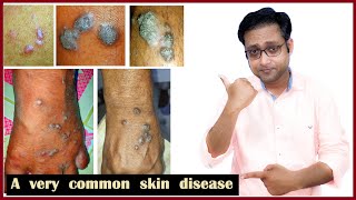 Lichen planus treatment  Hindi [upl. by Eiclek]