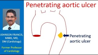 Penetrating aortic ulcer [upl. by Ahsikar]