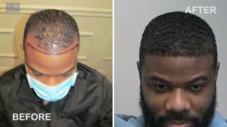 Amazing Hair Transplant Results Atrican American Hair  Before and After [upl. by Amalbena]