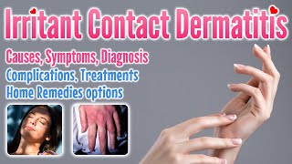 Irritant contact dermatitis overview causes symptoms treatment options and home remedies [upl. by Saint]