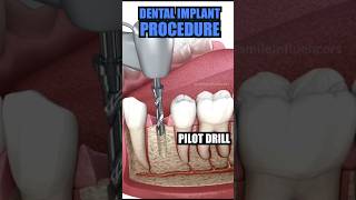 DENTAL IMPLANT 🦷 dentist trending dentisty viralvideo [upl. by Amsden7]