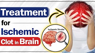 Treatment for Ischemic Clot in Brain  Ischemic Stroke in Paralysis  SRIAAS [upl. by Fachan378]