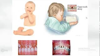 lecture 3 Dental caries with Dr omnya wahba clinical aspects  Classification of dental caries [upl. by Dlared]