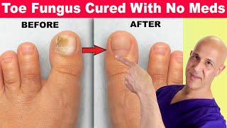 Toe Nail Fungus Cured With No Meds Dr Mandell [upl. by Natek]