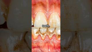 Gingivitis vs periodontistiswhats the difference [upl. by Ulric446]