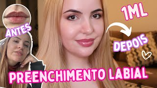 PREENCHIMENTO LABIAL COM 1 ML  ANTES E DEPOIS [upl. by Boniface765]