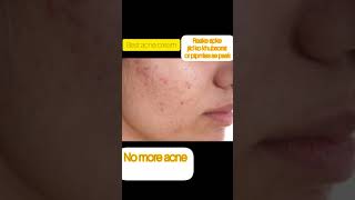 duac acne gel before and afterbest acne treatment by dermatologistacnetreatment trendingvideo [upl. by Neu456]