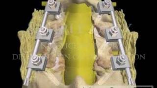 Lumbar Spine Pedicle Screw Fixation Fusion lawyer 3D animations [upl. by Chapell]