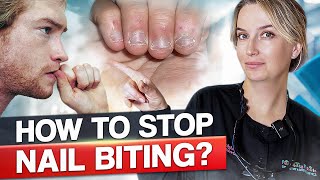 How to Stop Biting Nails [upl. by Avirt]