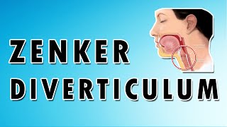 Zenkers Diverticulum [upl. by Gresham698]