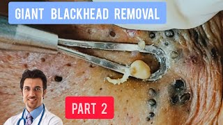 Massive blackhead removal inside a dermatology clinic  DrAMAZINGSKIN [upl. by Greeson603]