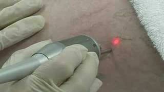 NdYAG Laser vascular removal [upl. by Dnomar]