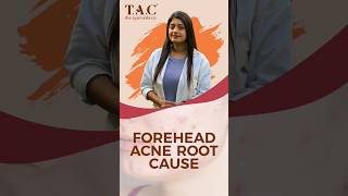 Reasons for Forehead Acne  Acne [upl. by Nayd]