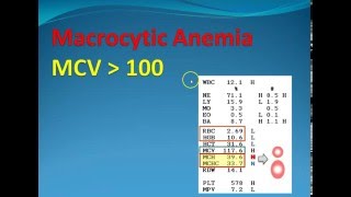 Hematology 2 Macrocytic Anemia [upl. by Buffo]