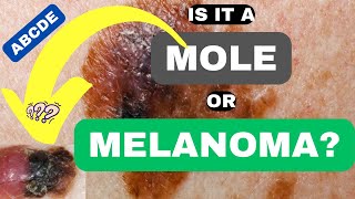 ABCDE of Melanoma Is it a Mole or Melanoma  ABCDE of Skin Cancer  Skin Cancer Symptoms and Signs [upl. by Niessuh569]