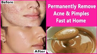 In 3 DAYS Permanently Remove Acne amp Pimples Fast at Home  Overnight Acne amp Pimples Treatment [upl. by Alfonso78]