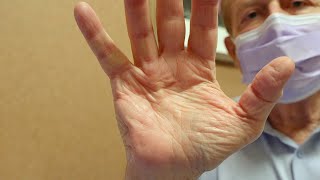 Mayo Clinic Minute  Treating Dupuytren’s contracture without surgery [upl. by Driskill]