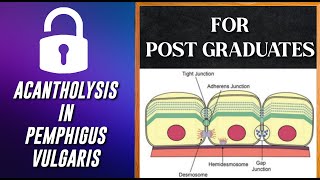 Acantholysis in Pemphigus Vulgaris For PG  DrTVanathi [upl. by Trinetta]