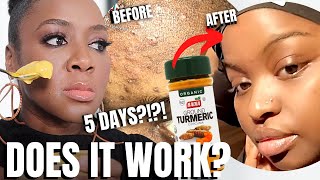 Does this DIY Turmeric Mask for Hyperpigmentation REALLY Work [upl. by Sillig]