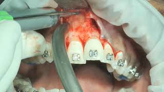 part 1 inverted and impacted  internal resorbed mesiodens surgical removal [upl. by Eben]