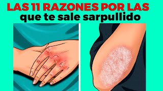 11 razones por las que te sale sarpullido o ronchas en el cuerpo [upl. by Oreste]