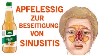 Wie du eine Sinusitis innerhalb von Minuten mit Apfelessig los wirst [upl. by Pinckney]