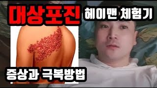 대상포진 증상과 극복방법 헤이맨 체험기 [upl. by Dloreh]