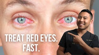 How to get rid of red eyes FAST  Ophthalmologist MichaelRChuaMD [upl. by Kuehn238]