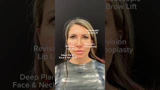 Facelift before and after browlift revisionrhinoplasty revisionfacelift liplift nycfacelift [upl. by Crystie]