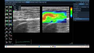 IQ 308 TFAST LUNG ULTRASOUND ELASTOGRAPHY PULMONARY EFFUSION  HWD COUGH HARD  FELINE [upl. by Dihahs]