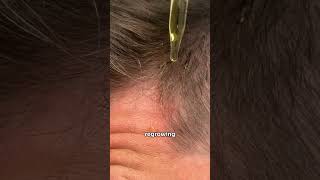 Do derma rollers help regrow hair hairloss hairlosstreatment hairgrowth dermaroller [upl. by Neira]