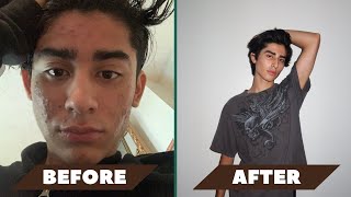 My Accutane journey [upl. by Remsen]