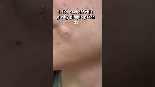 😮‍💨 GUNKY PIMPLE PATCH PEEL 😮‍💨 acneproneskin acne pimplepatch [upl. by Moina]