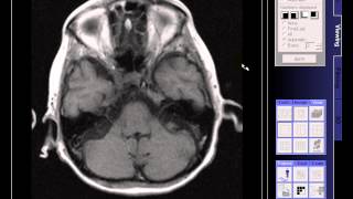 BRAIN MRI OLD INFARCTION [upl. by Desma]