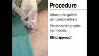 Pericardiocentesis by NEJM [upl. by Ahsek]