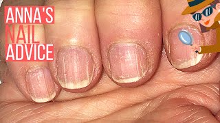 How To Care For Ridgy Nails ANNAS NAIL ADVICE 🕵️‍♀️ [upl. by Servais627]